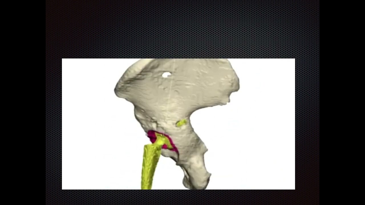 3D PRINTED ACETABULAR CUPS FOR HIP REPLACEMENT