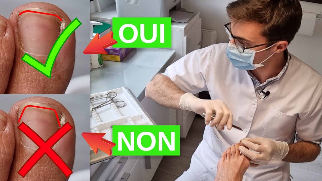 Comment se couper les ongles des pieds ? (et éviter les ongles incarnés)