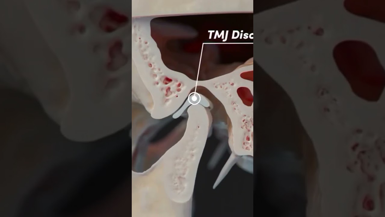 TMJ - Articular Disc & Lateral Pterygoid