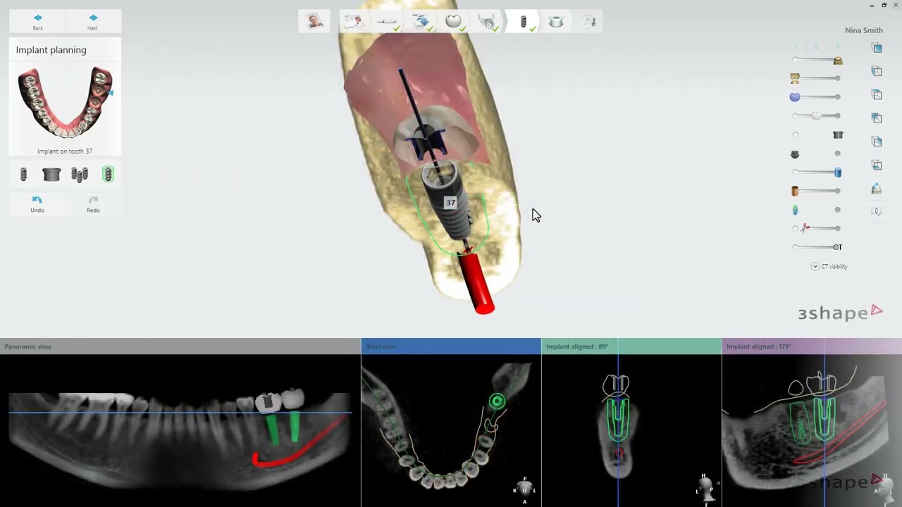 Planning and placing implants in Implant Studio