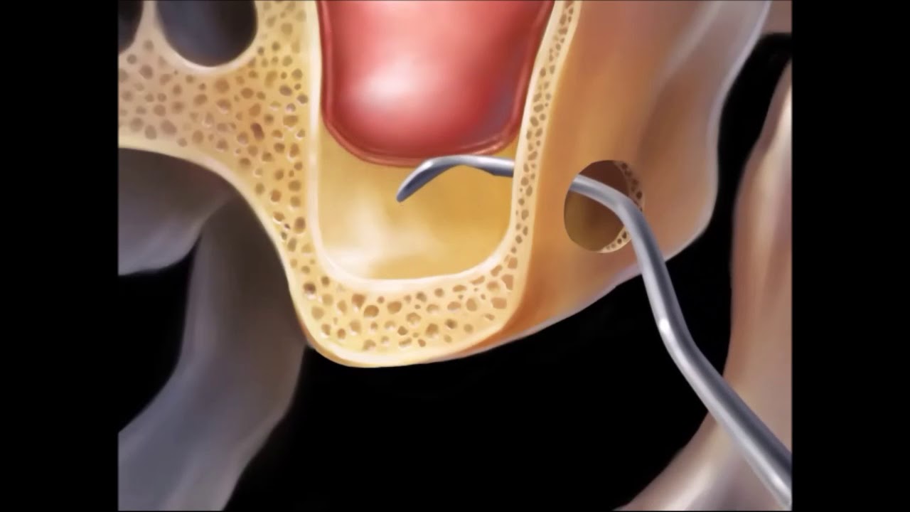 SINUS LIFT, podniesienie dna zatoki szczękowej