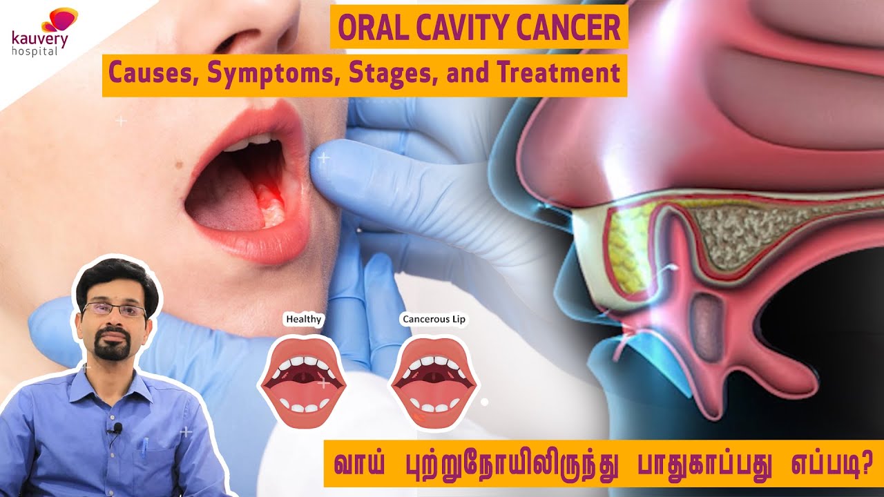 Oral Cavity Cancer - Causes, Symptoms, Stages, and Treatment