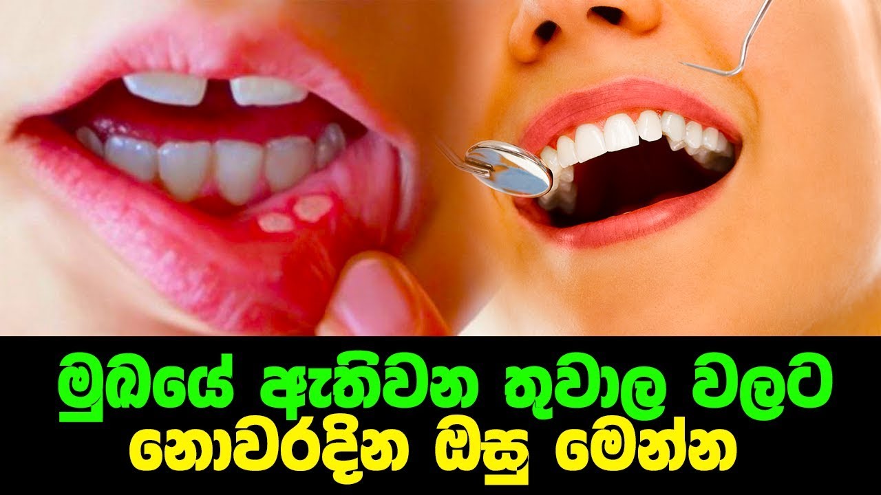 මුඛයේ ඇතිවන තුවාල වලට නොවරදින ඔසු මෙන්න