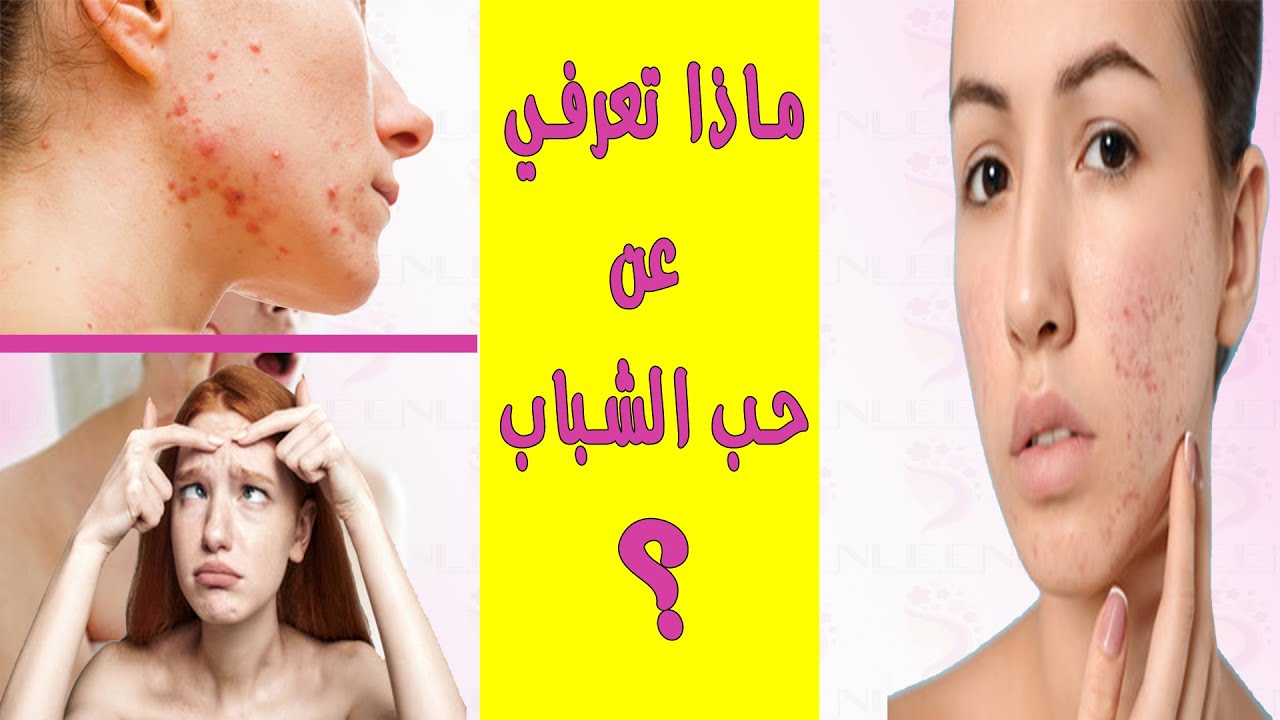 أسئلة تهمك حول حب الشباب