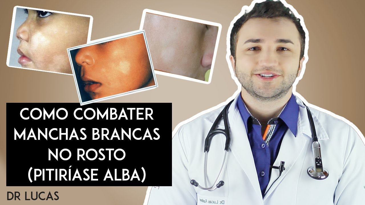 COMO COMBATER MANCHAS BRANCAS NO ROSTO (PITIRIASE ALBA) DR LUCAS FUSTINONI