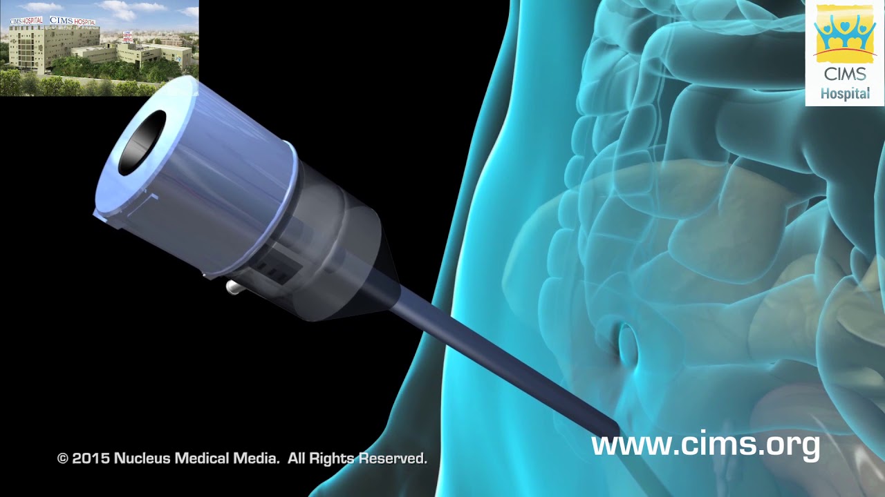 Diagnostic Pelvic Laparoscopy (Hindi) – CIMS Hospital