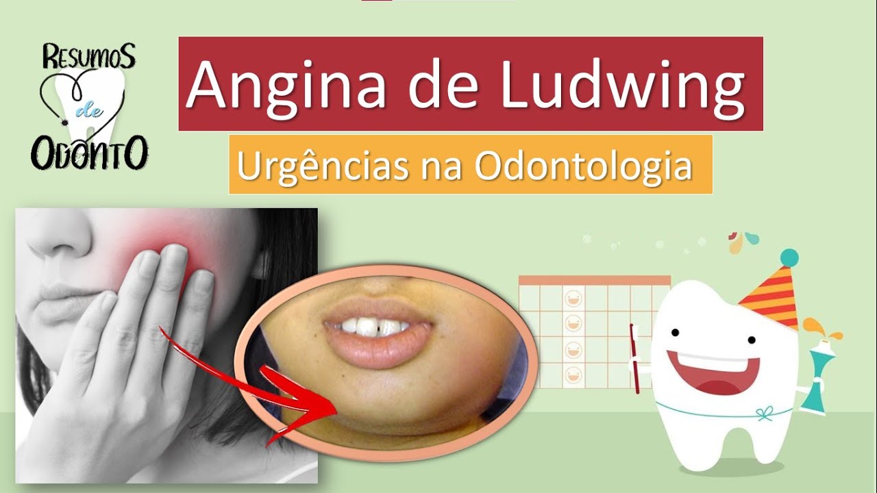 Angina de Ludwing - Urgências na Odontologia | Resumos de Odonto