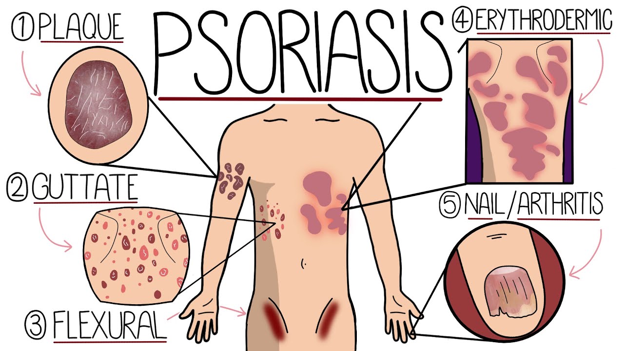 Psoriasis Explained Clearly - Including Types and Treatment