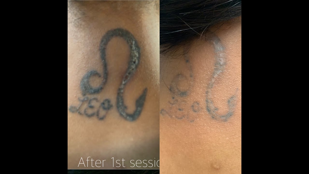 Tattoo Removal on Dark Skin | Military