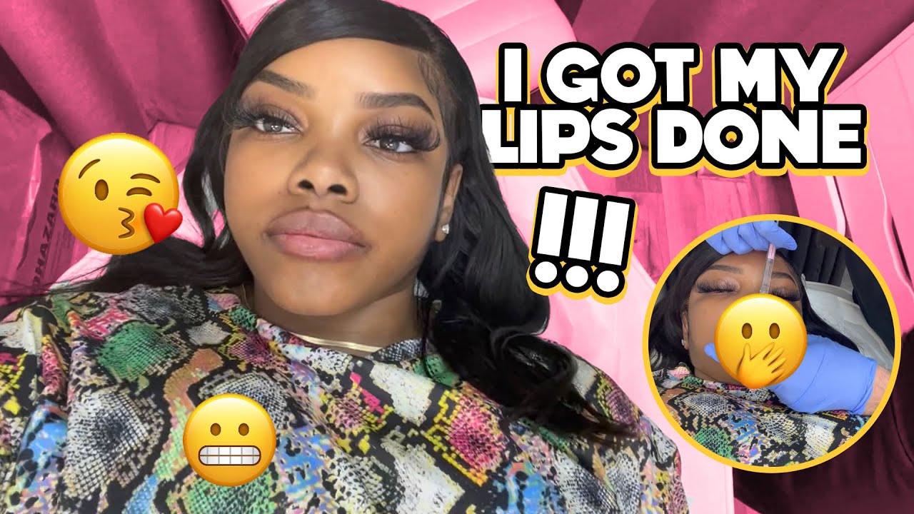 VLOG: I GOT MY LIPS DONE  | BLACK GIRL GETS LIP FILLERS | 