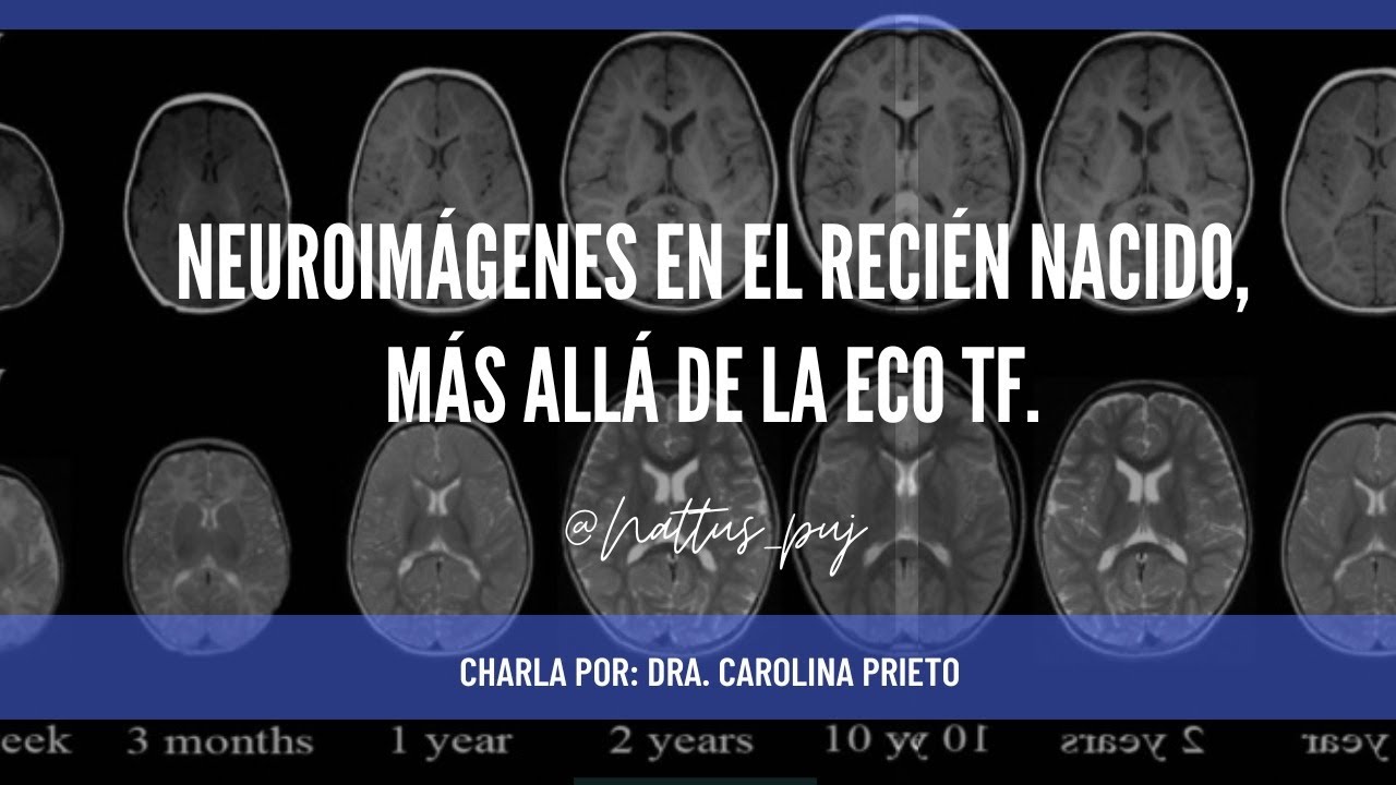Neuroimágenes en el recién nacido, más allá de la ECO TF