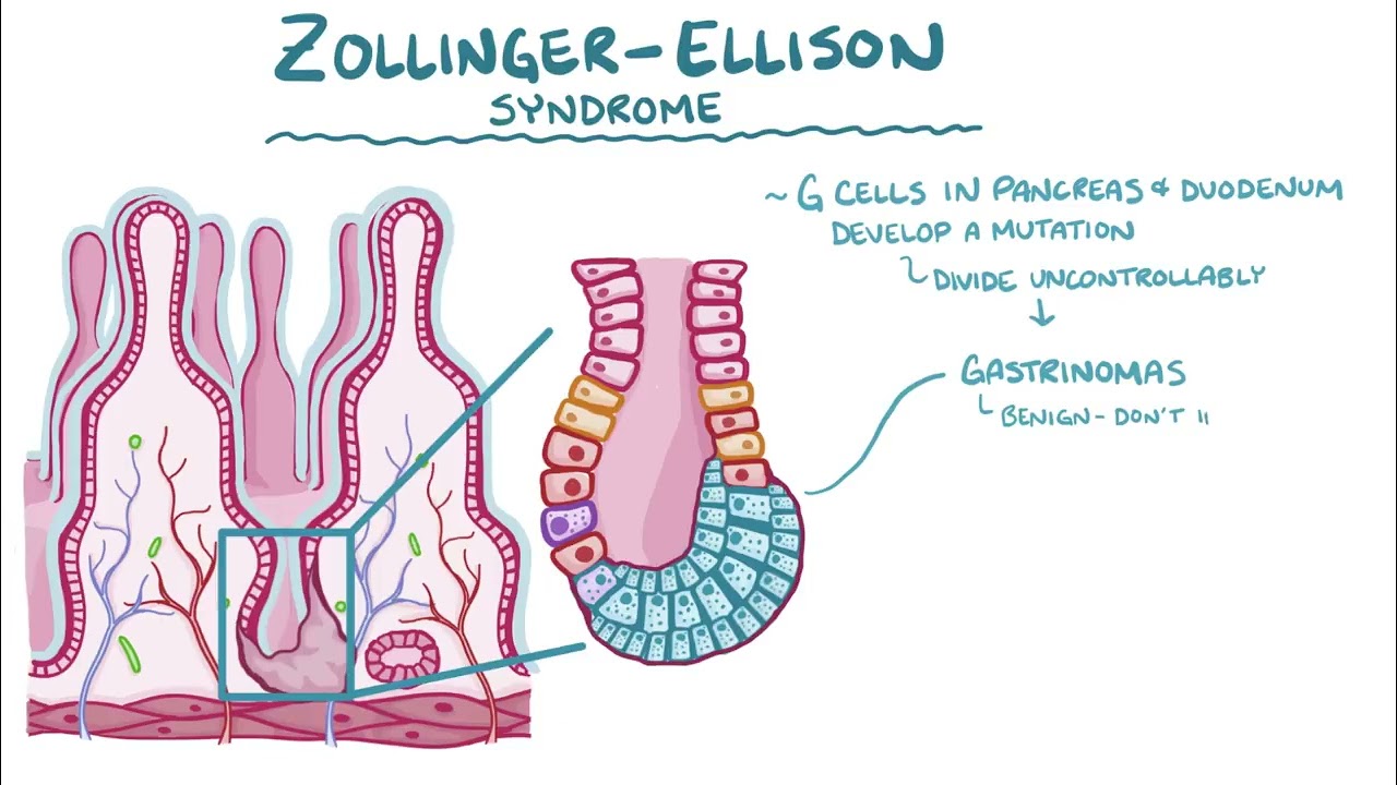 zollinger Ellison syndrome