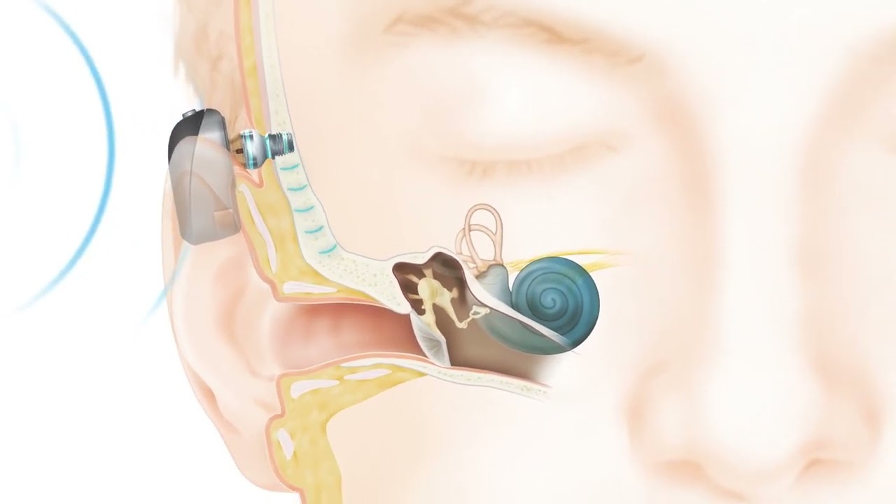Como o Sistema Cochlear™ Baha® Connect funciona