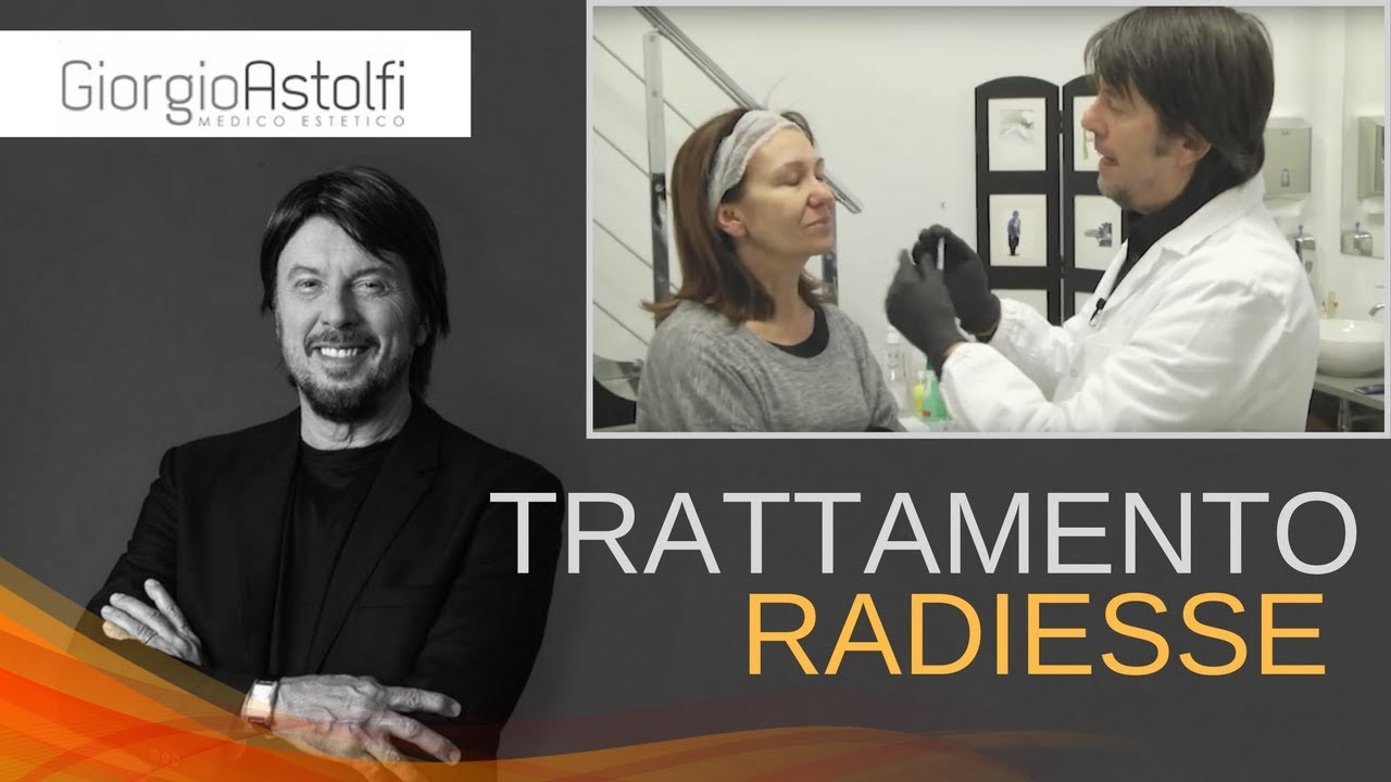 Trattamento del Viso con Radiesse [Dr. Giorgio Astolfi]
