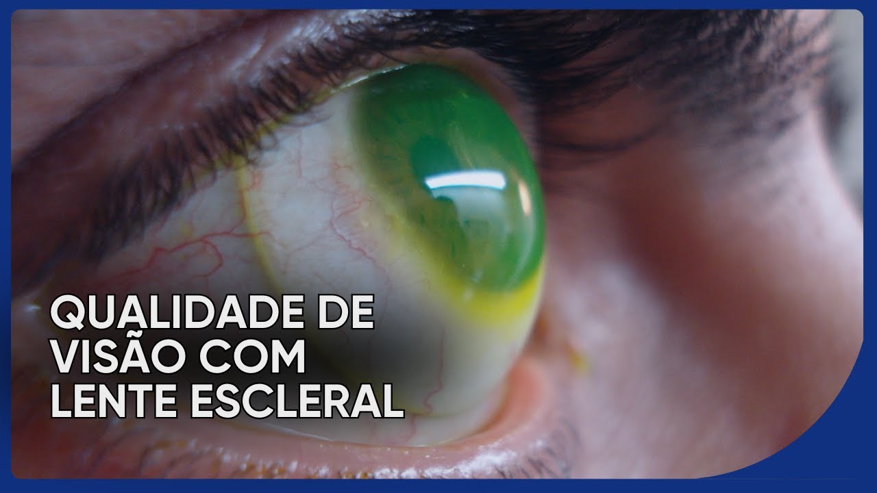 Visão Borrada nunca mais: LENTE ESCLERAL