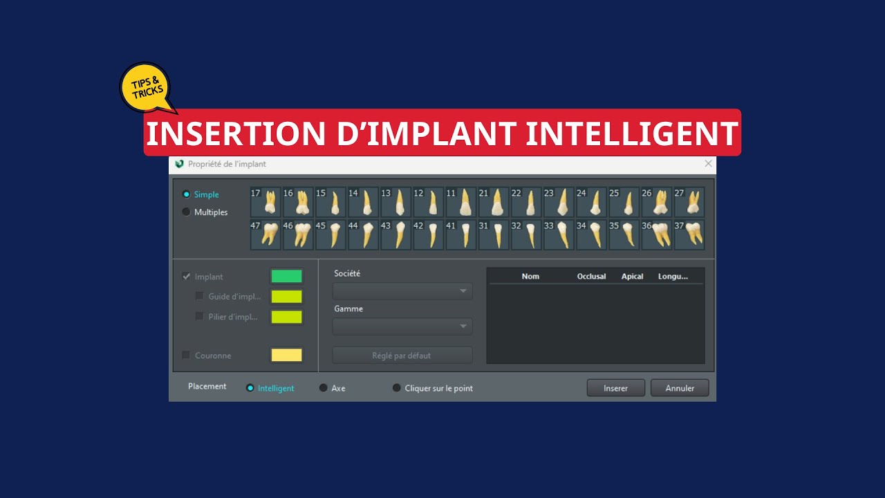 [TIPS & TRICKS]_Insertion d'implant intelligent