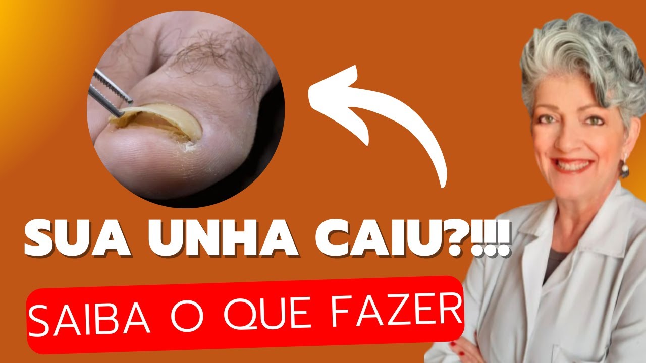 Minha UNHA CAIU!!! O Que Fazer