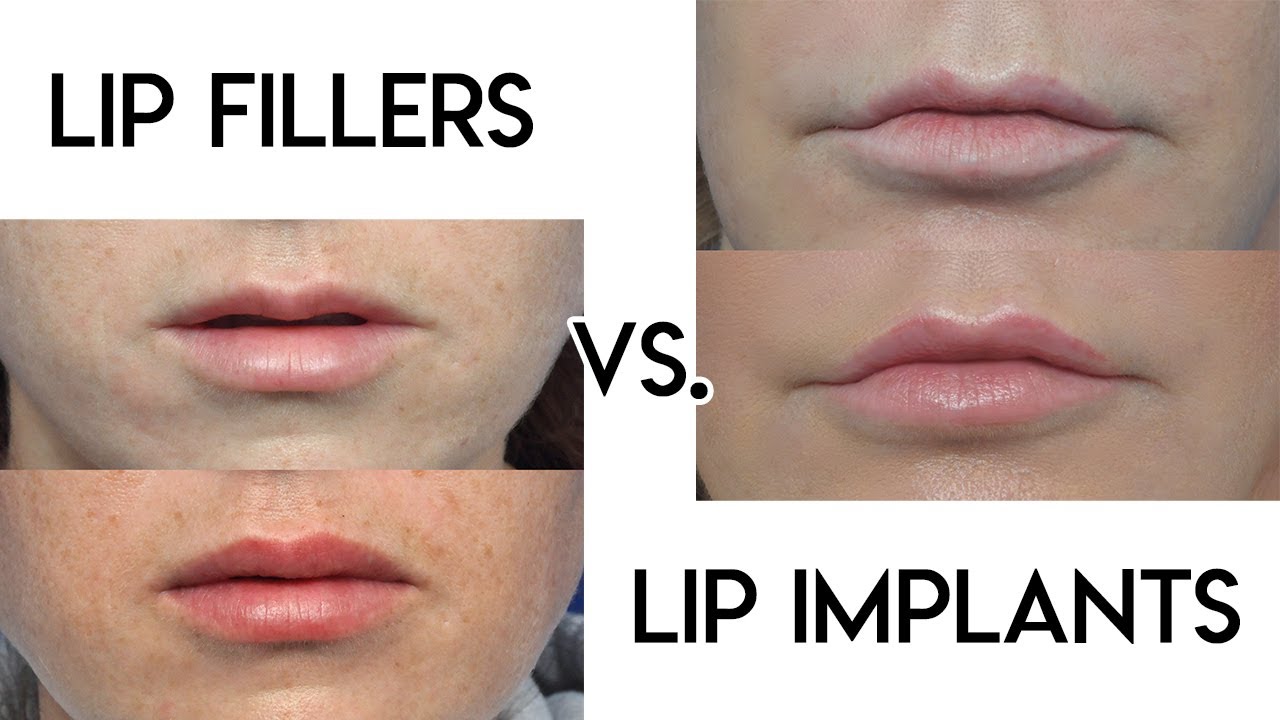 Lip Filler vs Lip Implants
