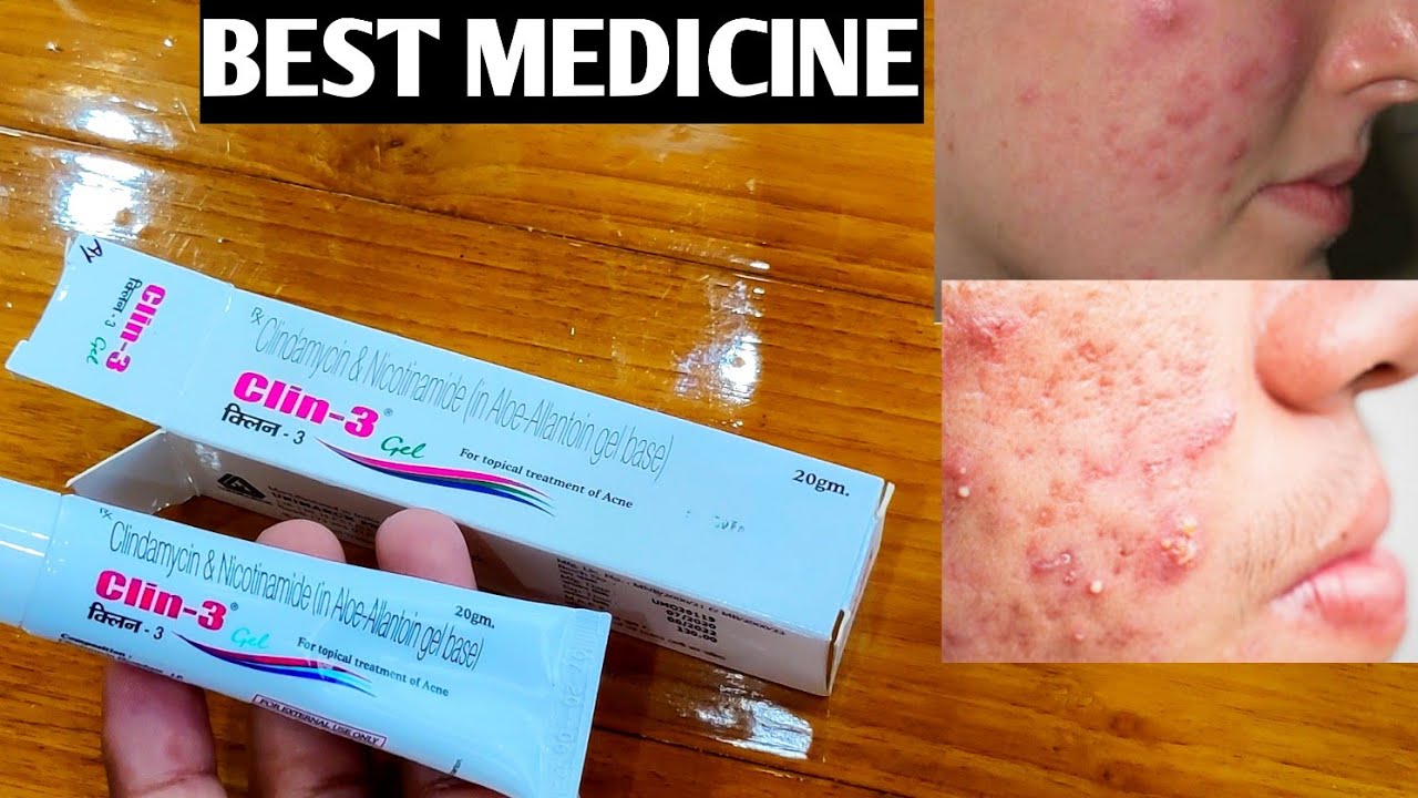 Clin 3 Gel Unboxing & Review !! चेहरा&nbsp;साफ करने और&nbsp;मुंहासे हटाने&nbsp;की Best दवा !! Best Cream for Pimple