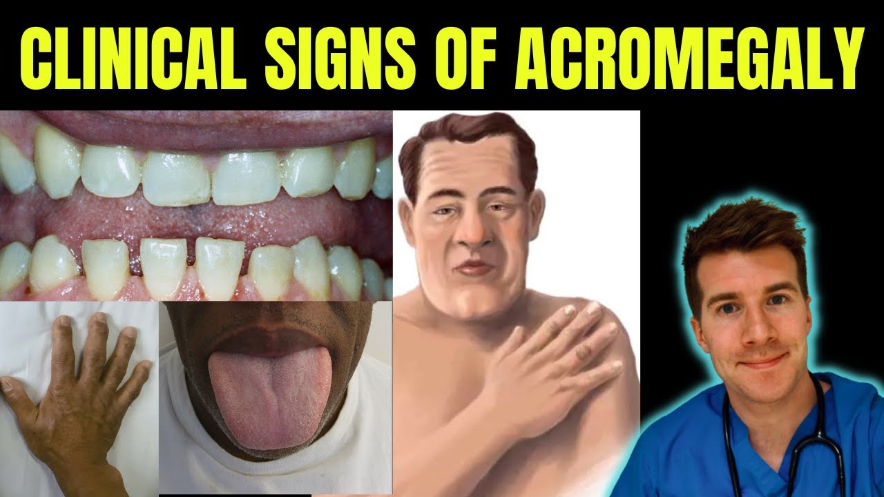 Acromegaly (gigantism) explained | Symptoms, causes, treatment