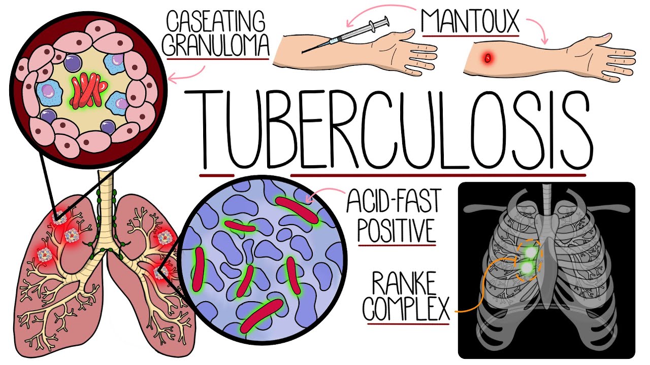 Tuberculosis Made Easy