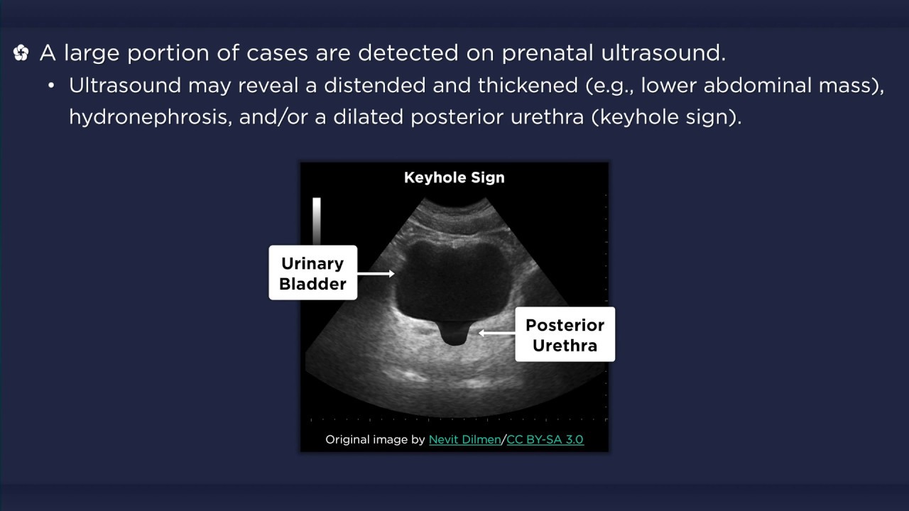 Posterior Urethral Valves