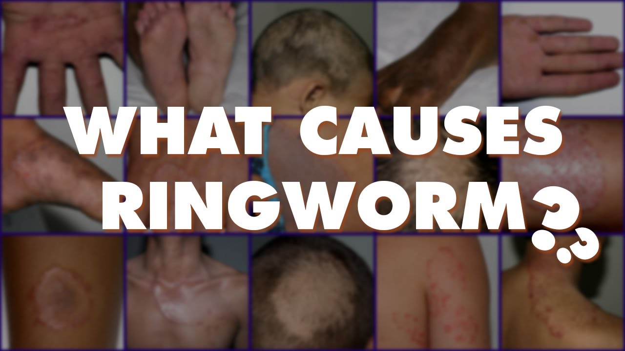 Ringworm- Dr Explains- Signs Symptoms Pictures