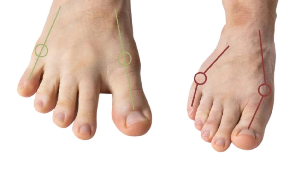 The basis of healthy walking: Learn to correctly position your foot
