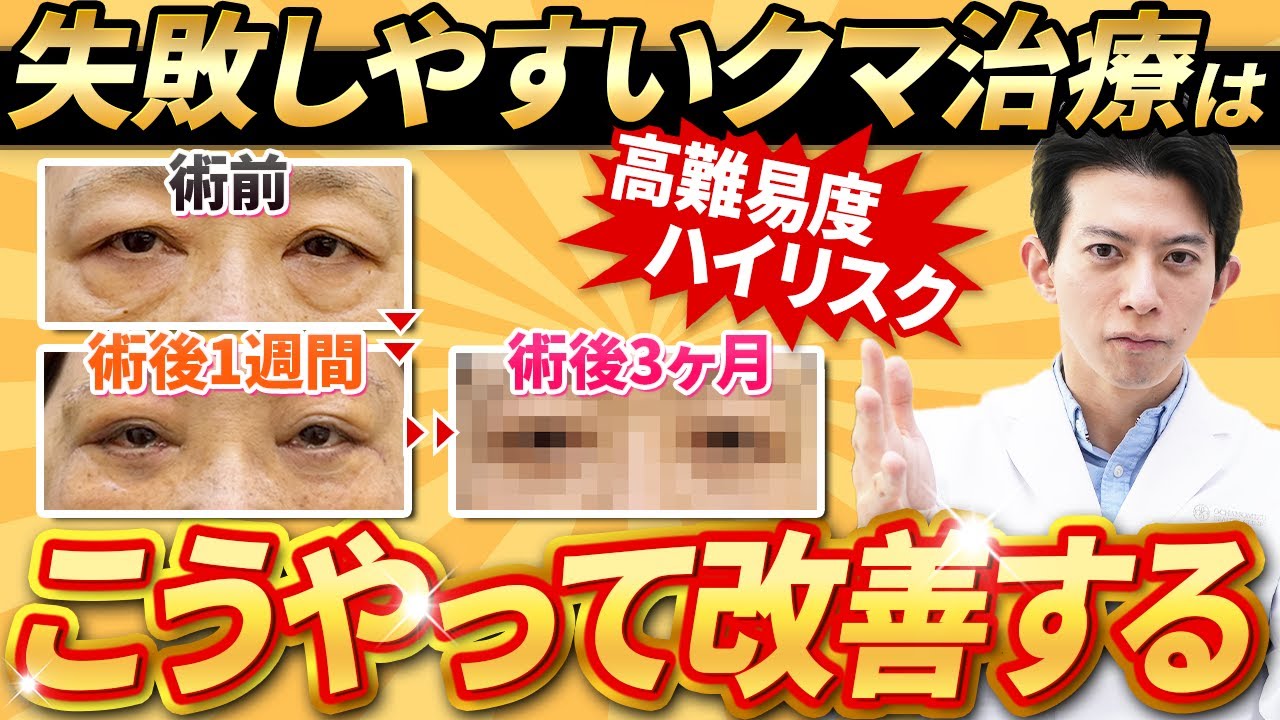 【症例解説】失敗したくない人は見て！高難易度の目の下のクマはこうやって改善します【クマ取り/経結膜脱脂/裏ハムラ法/表ハムラ法/クマ取り脂肪注入】
