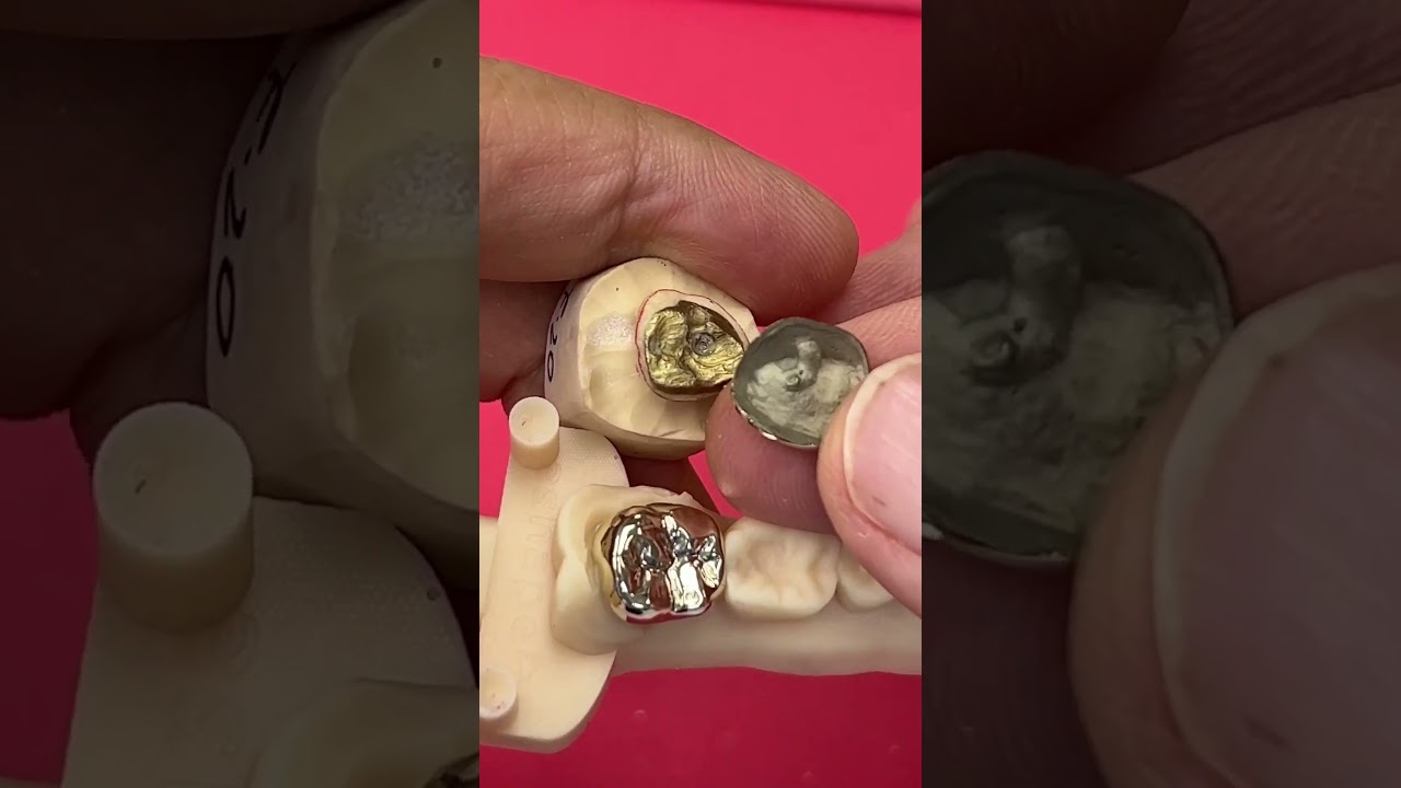 14Kt Gold Crowns in the place of Zirconia!