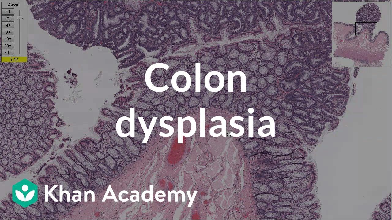 Colon dysplasia | Gastrointestinal system diseases | Health & Medicine | Khan Academy