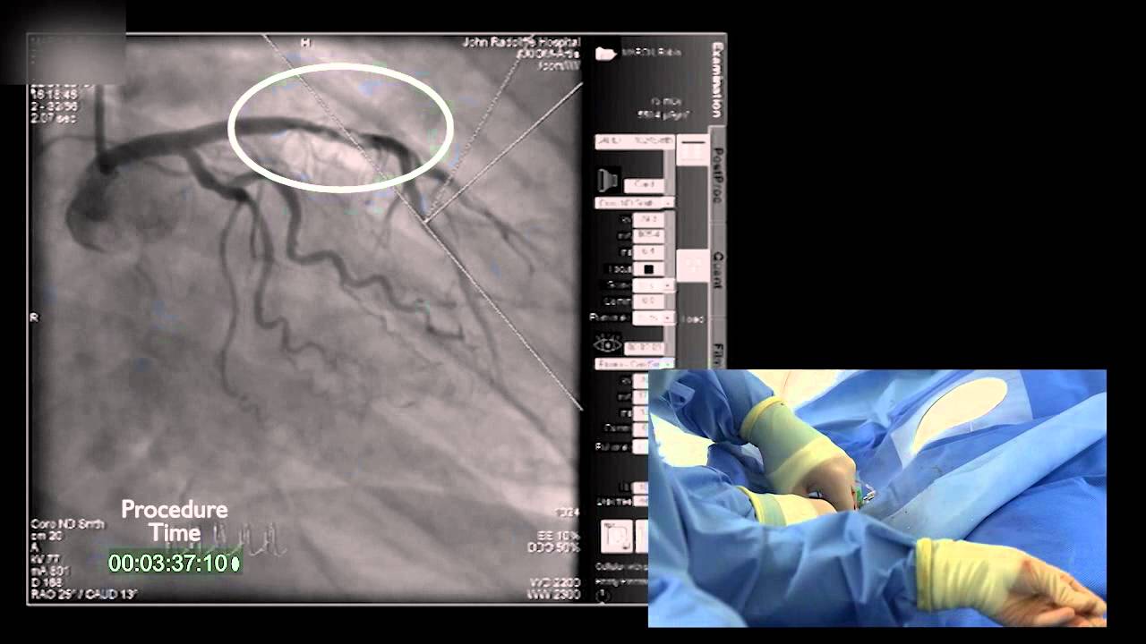 23 minutes - the story of a real heart attack, Oxford
