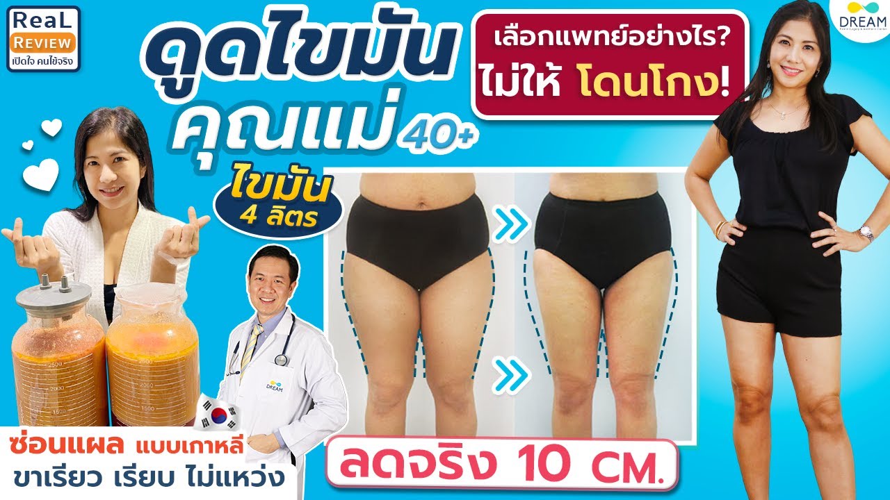 #ดูดไขมัน ลดต้นขา แบบ360องศา ขาเรียวสวย ไม่หย่อนย้วย ลดข้างละ10เซน