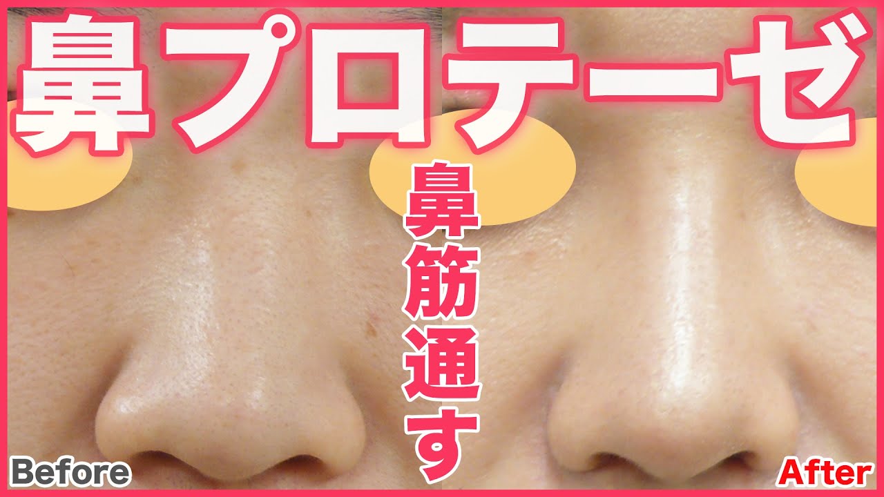 【鼻整形】鼻プロテーゼで印象はどう変わる？症例写真を用いて徹底解説