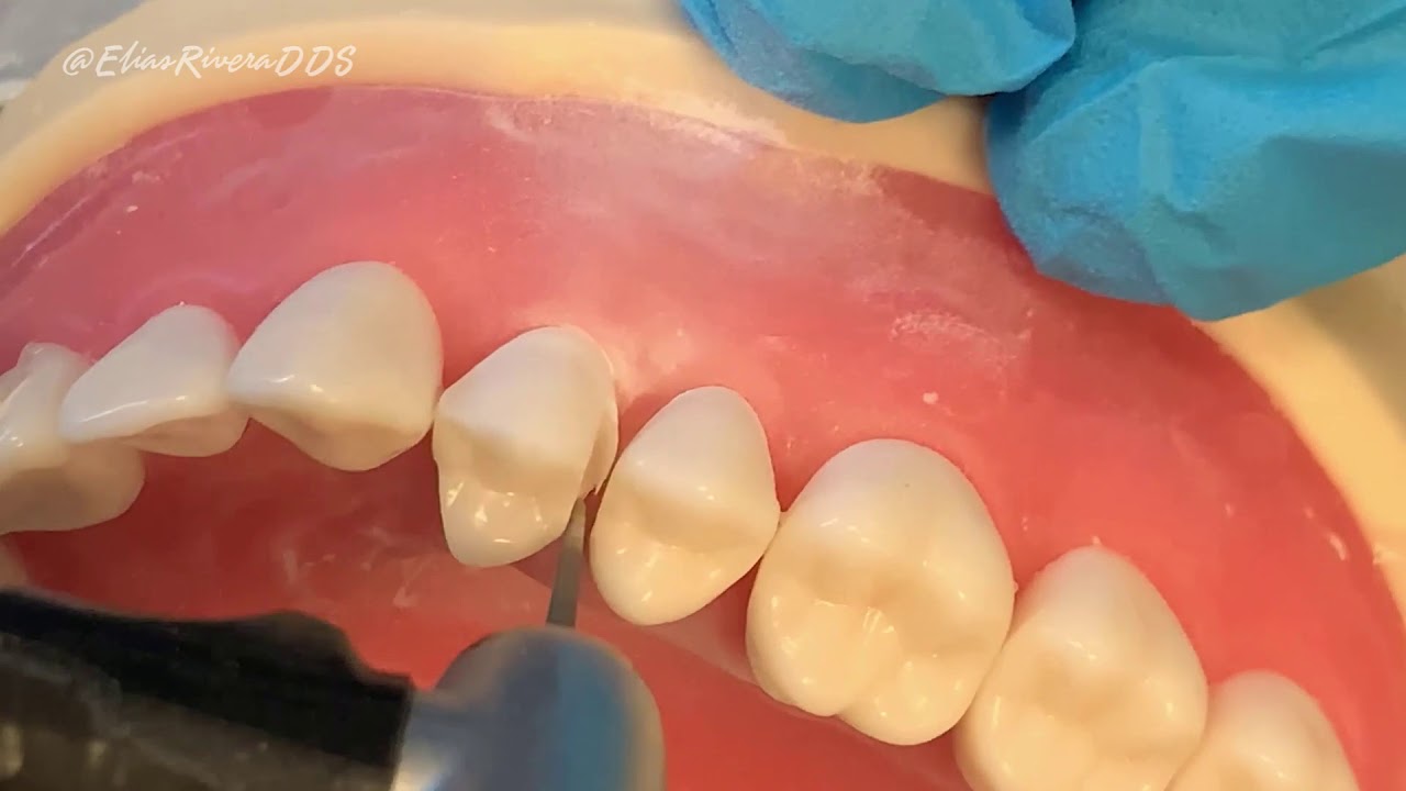 REST 528 - PFM Crown Prep #12