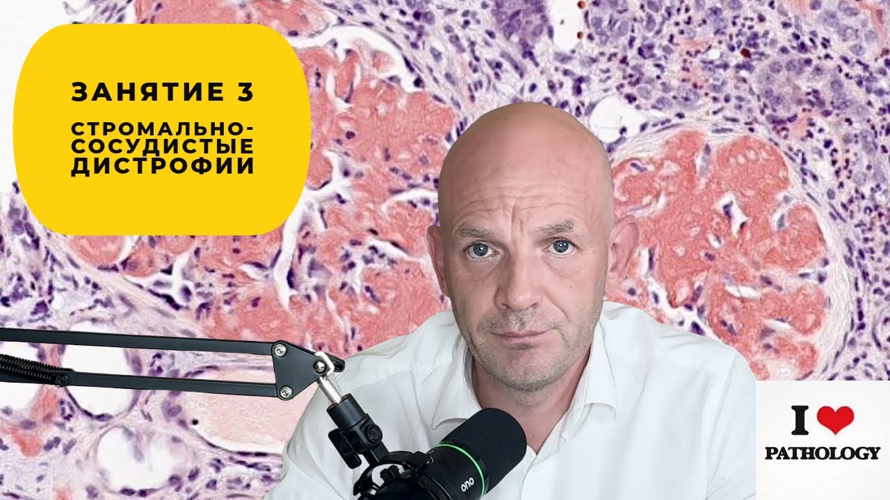 Стромально-сосудистые (внеклеточные) дистрофии - краткий обзор занятия №3