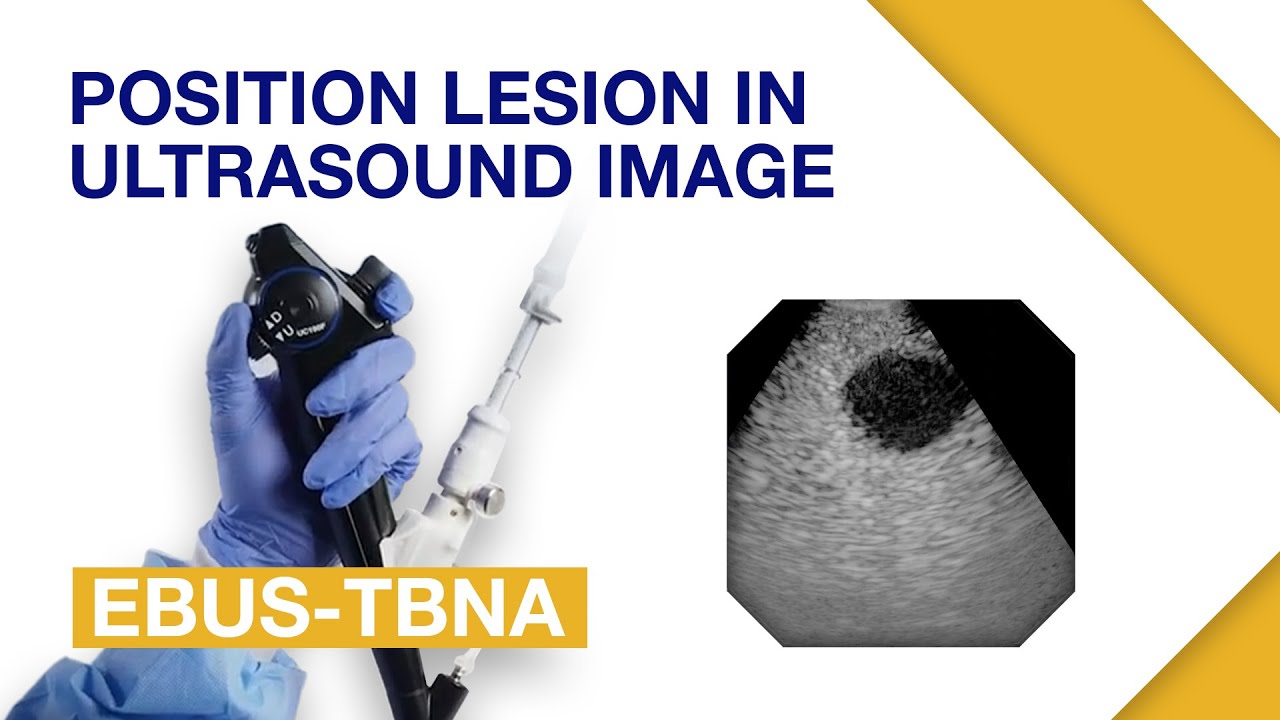EBUS-TBNA | Positioning the Lesion in Ultrasound Images | Respiratory