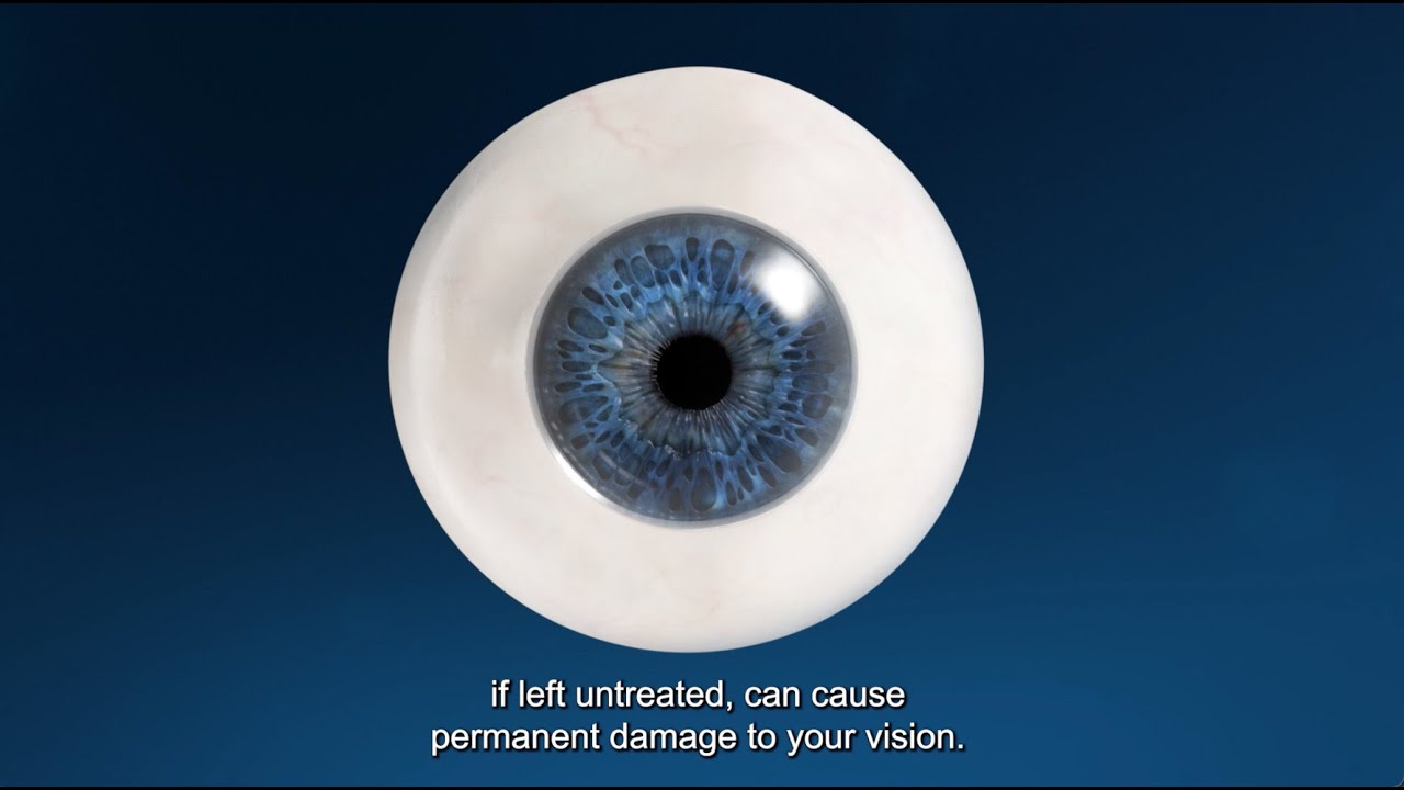 Glaucoma and the OMNI Surgical System Explained - Patient Education Video