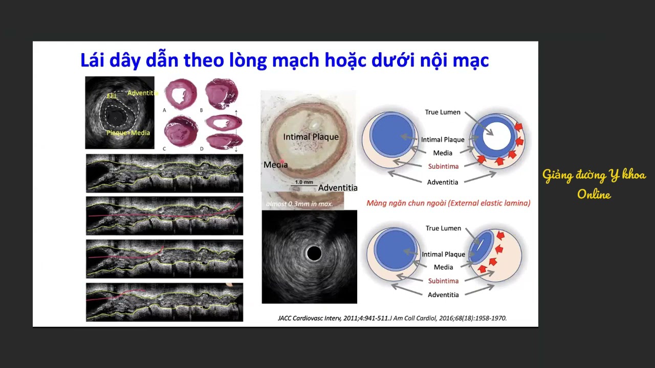 Can thiệp ngược dòng tổn thương tắc nghẽn mạn tính - Từ lý thuyết đến thực hành