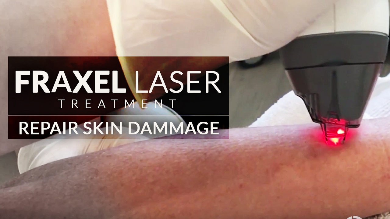 Fraxel Laser Treatment | Laser for Arms | Skin Damage | Wrinkle Improvement
