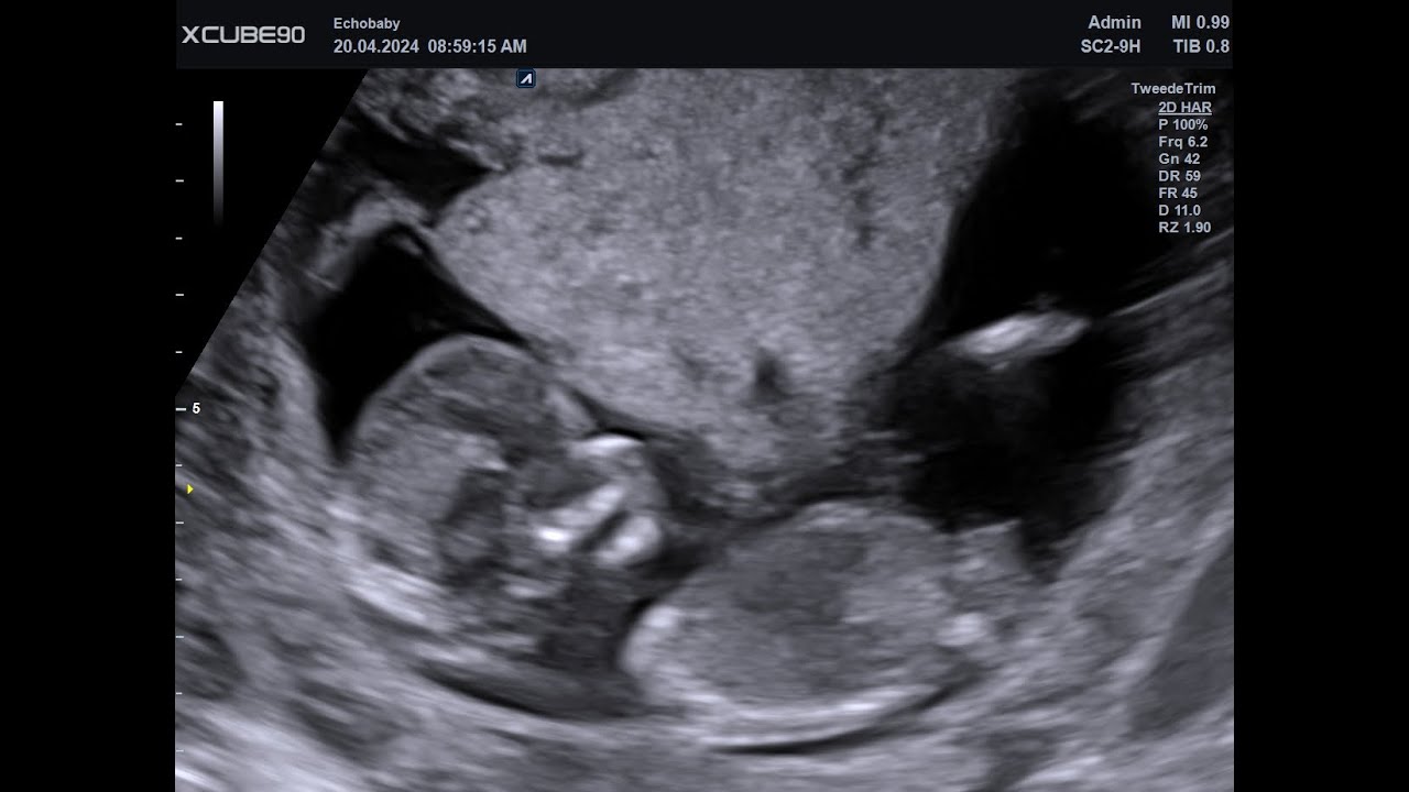 2D Echo 13 Weken Geslachtsbepaling Meisjes