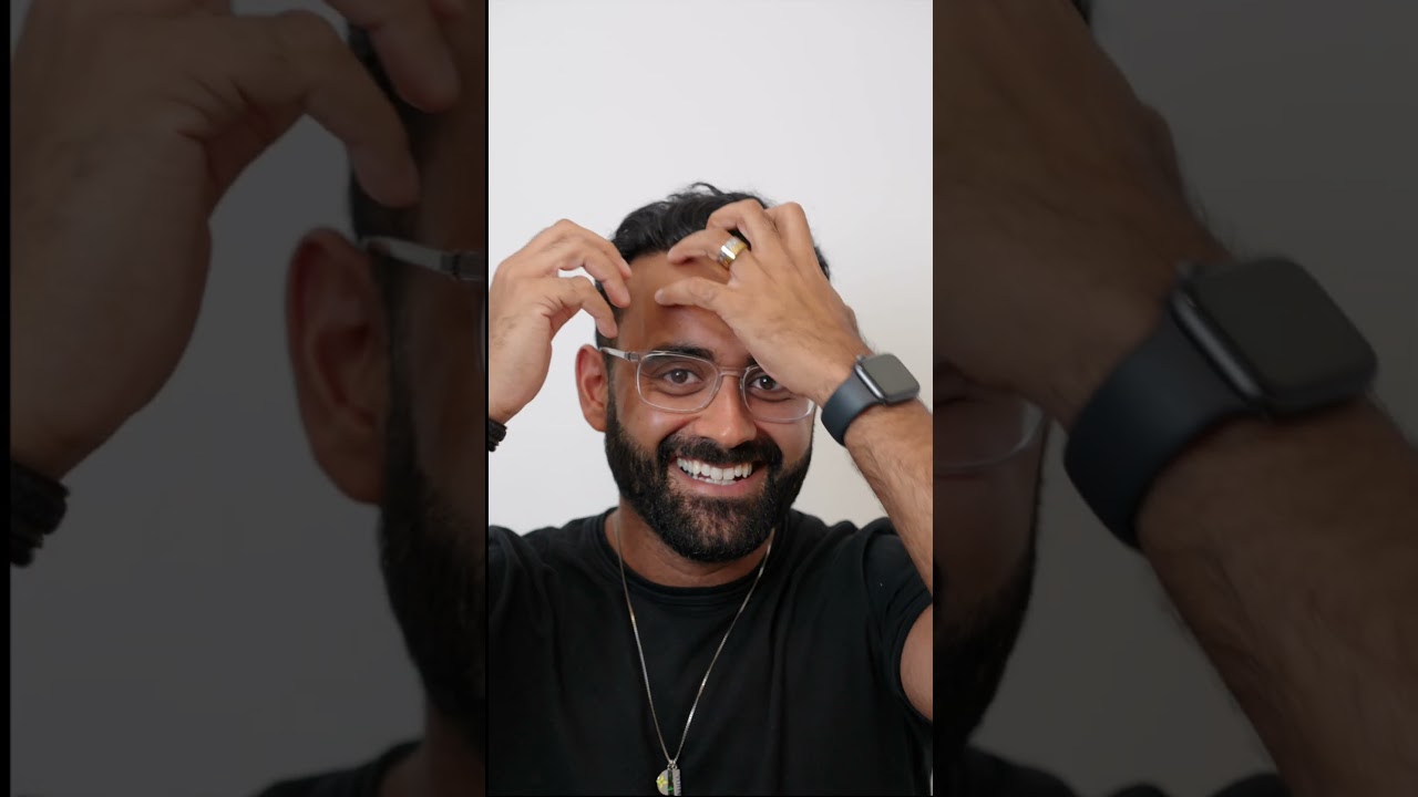 🔥 8 Months After Hair Transplant &ndash; Rish&rsquo;s Incredible Transformation! | Este Medical Group