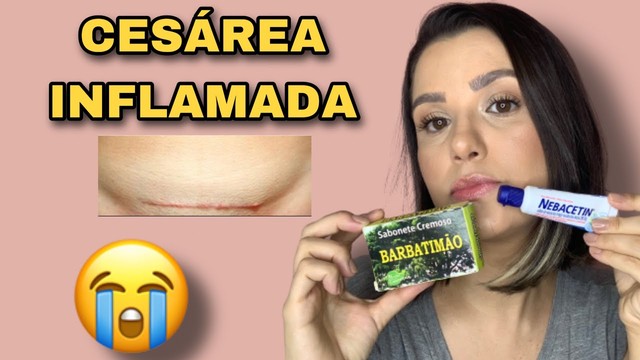 Como cuidar da Cesárea inflamada?