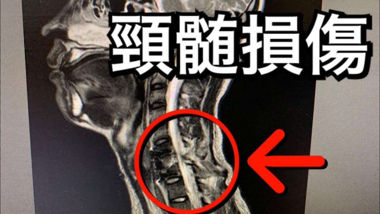 【頸髄損傷の実態】事故で首が取れかけた男の後遺症や感覚をお伝えします。