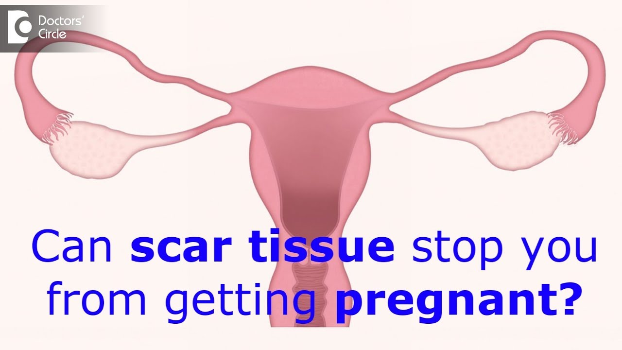 Can scar tissue stop you from getting pregnant? - Dr. Mangala Devi KR