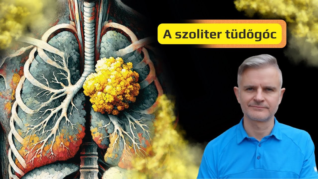 A szoliter tüdőgóc | Amit a radiológusnak tudnia kell 2024-ben