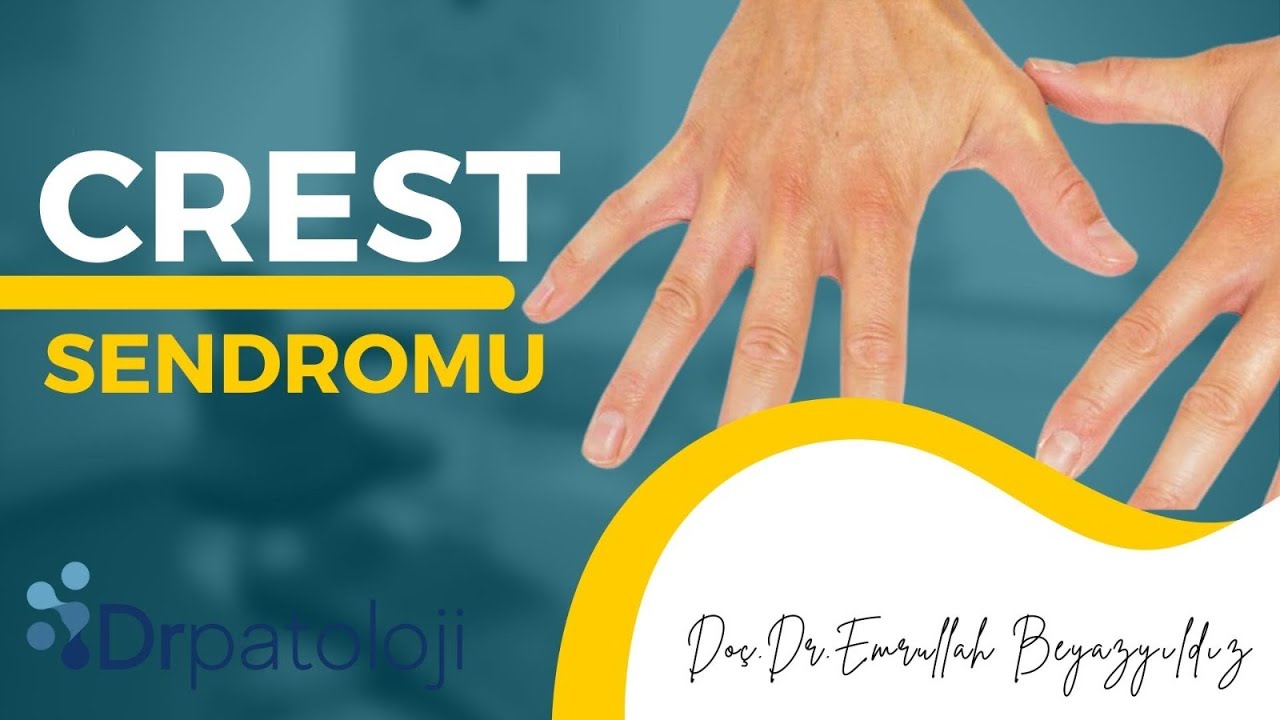 CREST SENDROMU