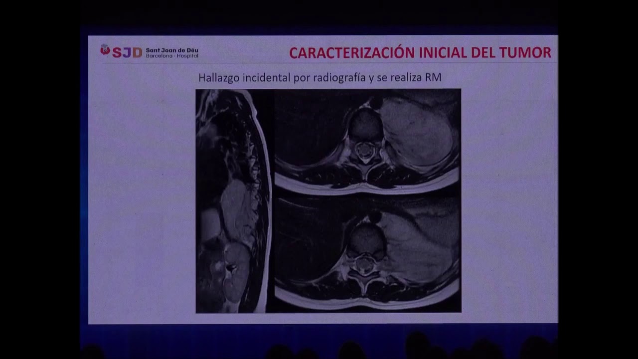 RM funcional en el neuroblastoma. Emilio Inarejos Clemente