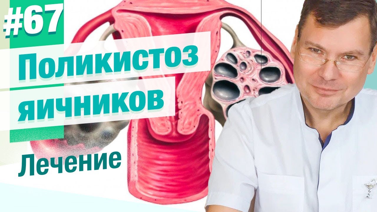 Как лечат поликистоз яичников?