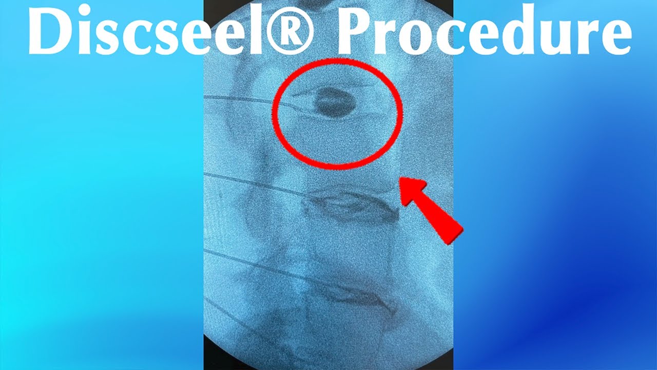 DISCSEEL против Deuk Laser Disc Repair®: реальный пример на L3/L4 и L4/L5